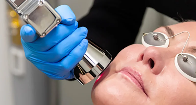 NanoLaserPeel™