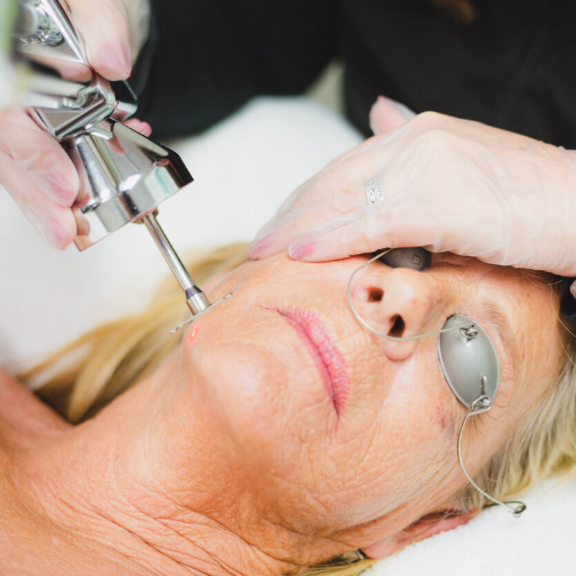 ProFractional laser
